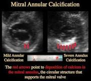 Image result for icd 10 cm code for mitral annular calcification