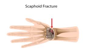 Image result for Scaphoid Bone