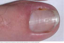 Just cut straight across and not at an angle. Ingrown Toenails Symptoms And Causes Mayo Clinic