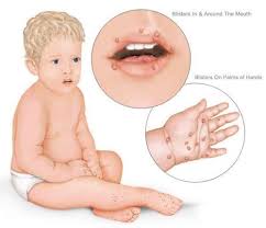 Image result for Hand foot and mouth disease HFMD roof of mouth