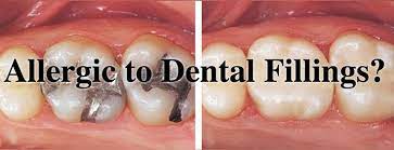 Dental Questions Can I Be Allergic To Dental Crowns Or Fillings Dental Dental Crowns Dental Fillings
