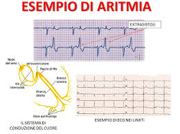 Există mai multe tipuri de aritmie sinusală, între care se înscrie și aritmia sinusală respiratorie. Le Aritmie