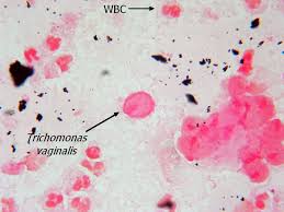 Fun With Microbiology (What's Buggin' You?): Trichomonas vaginalis