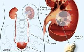 Kidney Stones Dissolve The Kidneys Rinse With Water Kidney Stones Treat Kidney Stones Kidney Infection