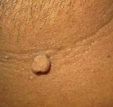 Como Quitar Verrugas En El Cuello