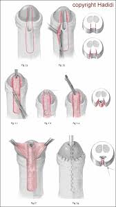 Image result for Chordee