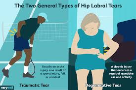 Image result for Hip Labral Tear