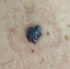 Melanoma Pictures Example Pictures Of Melanoma Symptoms