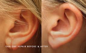 Navigating the choices for skin cancer treatment starts with understanding your options. Earlobe Repair Fayetteville Otolaryngology