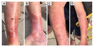 • symptoms of bleeding, easy bruising, night sweats, or weight loss suggest hematological malignancy or aplastic anaemia. Healthcare Free Full Text Presentation Of Acrodermatitis Chronica Atrophicans Rashes On Lyme Disease Patients In Canada Html
