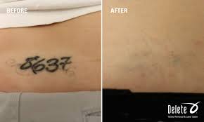 Select their name to learn more about their facility, education, and certifications. Tattoo Of Numbers Found On Lower Back Delete Currently Has Salons In Phoenix Az And Boston Ma Call For A Compli Tattoo Removal Laser Tattoo Removal Tattoos