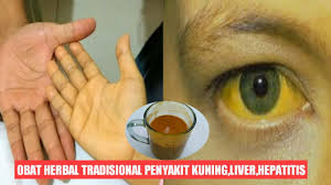 Yuk, ketahui fungsi, proses, dan efek sampingnya berikut ini. Manjur Obat Herbal Tradisional Penyakit Kuning Liver Hepatitis Youtube