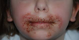 Peanut and tree nut allergies are likely to persist. Baby Wipe Chemical Tied To Allergic Reactions In Some Kids Cbs News