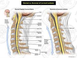 Medical Art Normal Vs Reversal Of Cervical Lordosis Stock Medical Illustrations Cervical Cervical Spinal Stenosis Medical Art