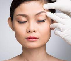 Some surgeons prefer to use an endoscope (a thin tube with a camera at the end) and special tools what is the process of eyebrow lifting with threads and without surgery? Eyebrow Lift If Using Pdo Thread Recovery Time Side Effect Cost Of Lift In Maimi