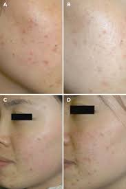 How Red Light Therapy Can Improve Your Skin It Treats Acne Wrinkles Pigmentation And More Pinterest Red Light Therapy Light Therapy And Red Lights