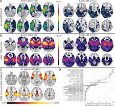 Image result for Neurologic Lesion Localization