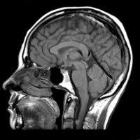 Exista doua tipuri principale de atrofie cerebrala. Irm Cranio Cerebral Biomed Scan
