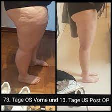 Die 420 Besten Ideen Zu 4 Fettabsaugen Liposuction Liposuktion Kosmetische Chirurgie Fettleibigkeit