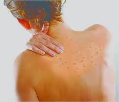 Vitamin Tuaran Pengedar Shaklee Sabah Cara Nak Hilangkan Jerawat Badan