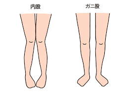 がに股の矯正方法は?自宅でできるケアを紹介 - 小林整骨院の体の悩み痛み改善コラム