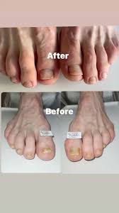 Image result for Onycholysis feet