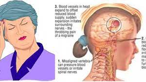 Inilah penyebab sakit kepala belakang : Jangan Anggap Sepele Jika Merasakan Sakit Kepala Bagian Belakang Tribun Jabar