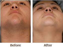 The type of laser machine used matters a lot when it comes to the price of the treatment. Laser Hair Removal Minneapolis St Paul Heather Rocheford Md