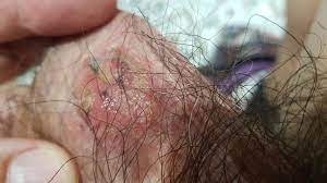 Me Ha Salido Una Erupcion Muy Molesta En Los Testiculos Dermatologo Net
