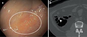 Image result for Colon Cancer Screening with Colonoscopy