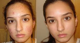Sivilce Ve Sivilce Izlerini Yok Eden Karbonat Maskesi Evde Nasil Yapilir Sivilce Izi Akne Tedavisi Skin Care