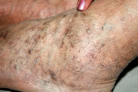 Image result for Pigment stains on the shin