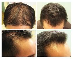 Hair transplantation clinic in los angeles. Ethnic Hair Loss Dermhair Clinic Los Angeles 1 310 318 1500