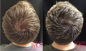 Then connect with providers in your area. Prp Hair Loss Before After Photos Male Female Platelet Rich Plasma For Hair
