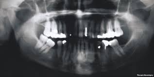 Endoscopic mucosecto my of early cancer and high grade dysplasia in barrett's esophagus // gastroenterology. Periapical Cemental Dysplasia