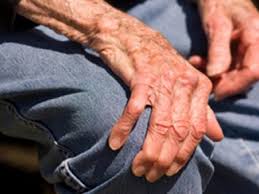 La esclerosis lateral amiotrófica comienza detectándose como una pérdida de la fuerza muscular en brazos y piernas, impidiendo hacer acciones cotidianas. Esclerosis Lateral Amiotrofica Sigue Sin Tratamiento Eficaz En Mexico