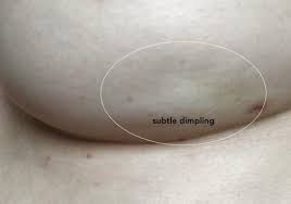 With inflammatory breast cancer, there may not be a lump. Claire Warner Diagnosed At 41 Detectogether