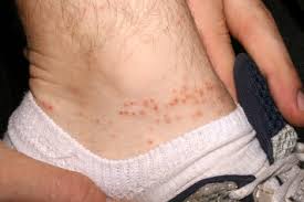 Image result for Trombicula autumnalis bites