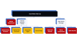 Image result for Acute Vision Loss