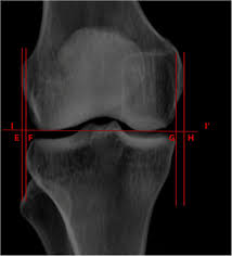 Sagittal plane fracture of the medial femoral condyle. The Distal Femur Is A Reliable Guide For Tibial Plateau Fracture Reduction A Study Of Measurements On 3d Ct Scans In 84 Healthy Knees Journal Of Orthopaedic Surgery And Research Full Text