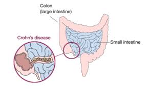 Discusses risk factors, symptoms, diagnostic procedures, and complications of crohn's disease. Crohn S Disease Bonheur Md Gastroenterologist