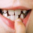 Traumatics Dental Injuries