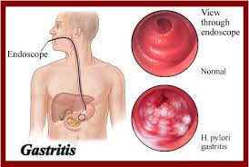Gastritis merupakan penyakit atau gangguan dimana dinding lambung mengalami peradangan. Pengertian Tanda Tanda Dan Gejala Gastritis Beserta Faktor Penyebabnya Masterpendidikan Com