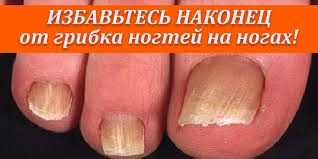как вылечить грибок на ногах в домашних условиях видео Mazi S Uksusom Svezhee Yajco Kuricy Zalit 100 G Uksusnoj Essencii Ostavit V Temnom Meste Na 5 7 Dnej Chtoby Rast V 2020 G Zdorove Zdorovye Nogti Tovary Dlya Zdorovya