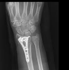 Zeitplan Fingerbeweglichkeit Nach Armbruch Behandlung In Der Physiotherapie Physiowissen De Physiotherapie Portal Forum