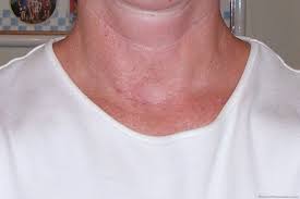 Thyroid Surgery Recovery Photos Progress Reports What To Expect After Thyroid Surgery Thyroid Surgery Thyroid Surgery Recovery Thyroid Surgery Scar