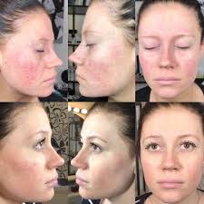 ARRBEHANDLING-Forbedring av hud kvaliteten🌸 Er du plaget med tørr/fet hud,  kviser, arr eller at huden ser matt og sliten ut så har vi hudbehandling  som gir fantastiske resultater🤗 Denne kunden hadde store