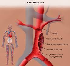 The bulge or ballooning may be defined as a Thoracic Aortic Aneurysm Johns Hopkins Medicine