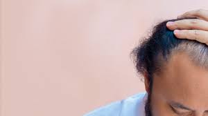 Isotretinoin must not be taken by patients who are pregnant or who may become pregnant. Hair Loss On Accutane No More Hair Loss Problem