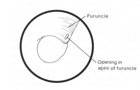 Image result for Acute Otitis Externa